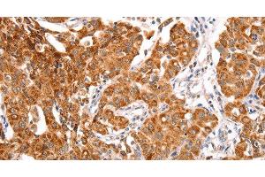 Immunohistochemistry of paraffin-embedded Human lung cancer using TRAF5 Polyclonal Antibody at dilution of 1:30 (TRAF5 抗体)