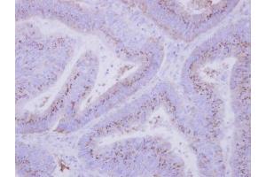 IHC-P Image Immunohistochemical analysis of paraffin-embedded human colon carcinoma, using INPP5F, antibody at 1:500 dilution. (INPP5F 抗体)