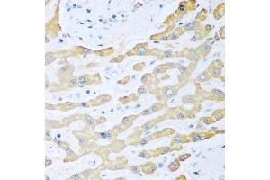 Immunohistochemistry of paraffin-embedded human liver cancer using FDXR antibody at dilution of 1:100 (40x lens). (Ferredoxin Reductase 抗体)