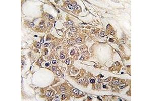IHC analysis of FFPE human breast carcinoma tissue stained with Vimentin antibody
