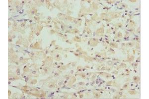 Immunohistochemistry of paraffin-embedded human gastric cancer using ABIN7162247 at dilution of 1:100 (OPA3 抗体  (AA 25-179))