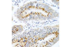 Immunohistochemistry of paraffin-embedded human colon carcinoma using FAM3B antibody at dilution of 1:100 (40x lens). (FAM3B 抗体)