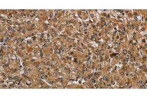 Immunohistochemistry of paraffin-embedded Human prostate cancer tissue using IKBIP Polyclonal Antibody at dilution 1:40 (IKbIP 抗体)