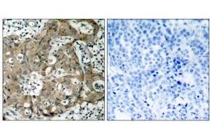 Immunohistochemical analysis of paraffin-embedded human breast carcinoma tissue using FKHR (Ab-319) antibody (E021161). (FOXO1 抗体)