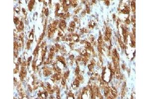 IHC testing of FFPE rhabdomyosarcoma with Muscle Actin antibody (Actin 抗体)