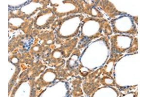 The image on the left is immunohistochemistry of paraffin-embedded Human thyroid cancer tissue using ABIN7130819(RASAL1 Antibody) at dilution 1/20, on the right is treated with fusion protein. (RASAL1 抗体)