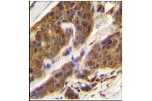 Immunohistochemistry analysis in Formalin Fixed, Paraffin Embedded Human bladder carcinoma stained with CFD Antibody (N-term) followed by peroxidase conjugation of the secondary antibody and DAB staining. (Adipsin 抗体  (N-Term))