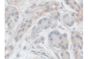 IHC-P analysis of Human Pancreatic cancer Tissue, with DAB staining. (VPS37A 抗体  (AA 1-397))
