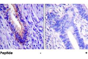 Immunohistochemical analysis of paraffin-embedded human colon carcinoma tissue using EIF4G1 polyclonal antibody . (EIF4G1 抗体)