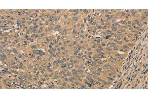 Immunohistochemistry of paraffin-embedded Human cervical cancer tissue using PRDM14 Polyclonal Antibody at dilution 1:30 (PRDM14 抗体)