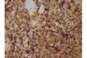 IHC image of ABIN7175671 diluted at 1:200 and staining in paraffin-embedded human ovarian cancer performed on a Leica BondTM system. (WFDC2 抗体  (AA 31-124))