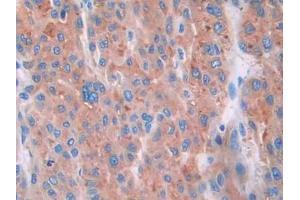 IHC-P analysis of Human Liver cancer Tissue, with DAB staining. (CUBN 抗体  (AA 3511-3623))