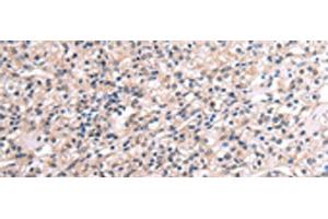 Immunohistochemistry of paraffin-embedded Human liver cancer tissue using RNF115 Polyclonal Antibody at dilution of 1:45(x200) (RNF115 抗体)