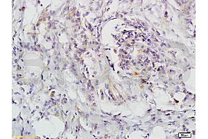 Formalin-fixed and paraffin-embedded human colon carcinoma labeled with Rabbit Anti-CD118 Polyclonal Antibody, unconjugated  (ABIN686827)  1: 200 followed by incubation with conjugated secondary antibody and DAB staining (LIFR 抗体  (AA 451-580))