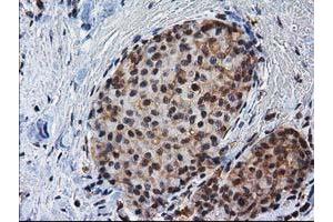 Immunohistochemical staining of paraffin-embedded Adenocarcinoma of Human breast tissue using anti-NHEJ1 mouse monoclonal antibody. (NHEJ1 抗体)