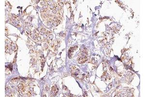 ABIN6275245 at 1/100 staining Human breast cancer tissue by IHC-P. (MRPL49 抗体  (Internal Region))