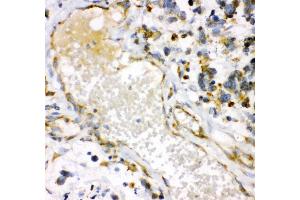 Anti- HMOX1 antibody, IHC(P) IHC(P): Human Lung Cancer Tissue (HMOX1 抗体  (AA 1-288))