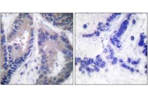 Immunohistochemistry analysis of paraffin-embedded human lung carcinoma tissue, using Collagen alpha1 XVIII Antibody. (COL18A1 抗体  (AA 1301-1350))