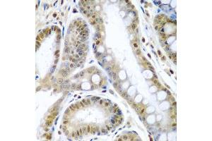 Immunohistochemistry of paraffin-embedded human colon carcinoma using TNFSF10 antibody (ABIN3023014, ABIN3023015, ABIN3023016 and ABIN6219347) at dilution of 1:200 (40x lens). (TRAIL 抗体  (AA 39-250))