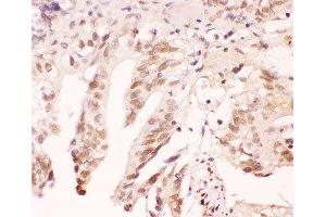IHC-P: ATF1 antibody testing of human intestinal cancer tissue (AFT1 抗体  (AA 1-271))