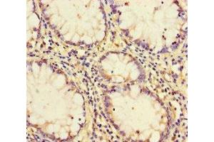 Immunohistochemistry of paraffin-embedded human colon cancer using ABIN7164149 at dilution of 1:100 (PCF11 抗体  (AA 409-604))
