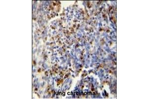 FOSL2 antibody (Center) (ABIN654925 and ABIN2844568) immunohistochemistry analysis in formalin fixed and paraffin embedded human lung carcinoma followed by peroxidase conjugation of the secondary antibody and DAB staining.