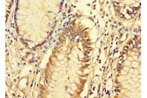 Immunohistochemistry of paraffin-embedded human colon cancer using ABIN7165398 at dilution of 1:100 (FAM135B 抗体  (AA 801-1100))