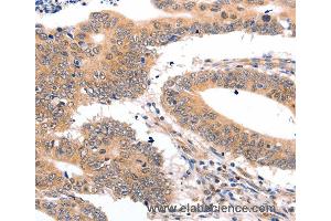 Immunohistochemistry of Human colon cancer using SEMA3G Polyclonal Antibody at dilution of 1:30