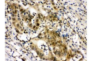 Anti- EIF6 Picoband antibody,IHC(P) IHC(P): Human Intestinal Cancer Tissue (EIF6 抗体  (AA 66-210))