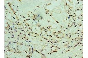 Immunohistochemistry of paraffin-embedded human breast cancer using ABIN7176056 at dilution of 1:100 (ZEB2 抗体  (AA 1050-1214))