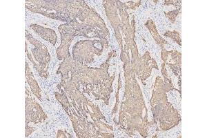 IHC analysis of Cytokeratin 19 using anti-Cytokeratin 19 antibody (ABIN3043288). (Cytokeratin 19 抗体  (C-Term))