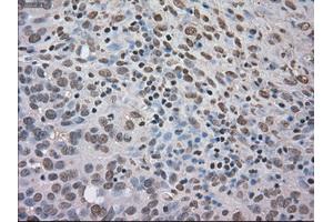Immunohistochemical staining of paraffin-embedded Adenocarcinoma of colon tissue using anti-NTRK3mouse monoclonal antibody. (NTRK3 抗体)