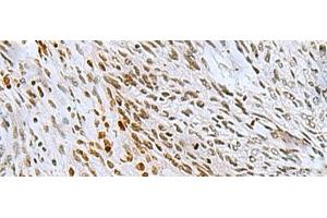Immunohistochemistry of paraffin-embedded Human lung cancer tissue using CNOT7 Polyclonal Antibody at dilution of 1:55(x200) (CNOT7 抗体)