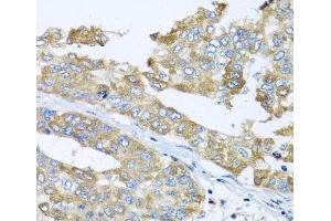 Immunohistochemistry of paraffin-embedded Human liver cancer using COQ7 Polyclonal Antibody at dilution of 1:100 (40x lens). (Coq7 抗体)