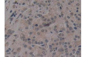 Detection of gp210 in Human Prostate cancer Tissue using Polyclonal Antibody to Nuclear Pore Glycoprotein 210 (gp210)