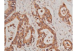 ABIN6268758 at 1/50 staining human colon cancer tissue sections by IHC-P. (CYP17A1 抗体  (Internal Region))