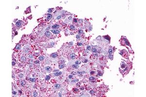 Anti-OPN5 antibody IHC of human Ovary, Carcinoma. (OPN5 抗体  (Transmembrane Domain))