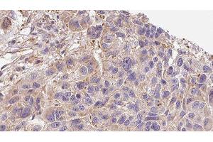 ABIN6276397 at 1/100 staining Human Melanoma tissue by IHC-P. (Interleukin 17a 抗体  (Internal Region))