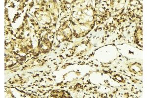 ABIN6267569 at 1/100 staining Human breast cancer tissue by IHC-P. (PRKDC 抗体  (pThr2647))
