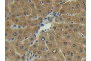 Detection of MMP13 in Human Liver Tissue using Polyclonal Antibody to Matrix Metalloproteinase 13 (MMP13) (MMP13 抗体  (AA 103-290))