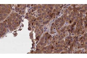 ABIN6277234 at 1/100 staining Human liver cancer tissue by IHC-P. (GNAO1 抗体  (Internal Region))