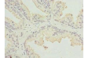 Immunohistochemistry of paraffin-embedded human prostate cancer using ABIN7158931 at dilution of 1:100 (MR1 抗体  (AA 20-260))