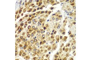 Immunohistochemistry of paraffin-embedded human liver cancer using SND1 antibody. (SND1 抗体)