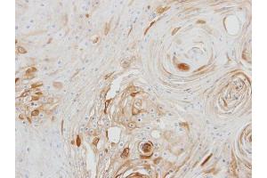IHC-P Image Immunohistochemical analysis of paraffin-embedded Ca922 xenograft, using BCAT2, antibody at 1:500 dilution. (BCAT2 抗体  (Center))