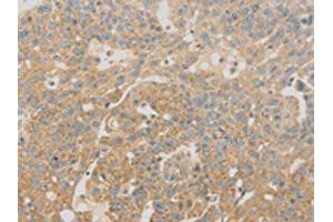 The image on the left is immunohistochemistry of paraffin-embedded Human breast cancer tissue using ABIN7130971(SCAP Antibody) at dilution 1/20, on the right is treated with fusion protein. (SREBF chaperone 抗体)