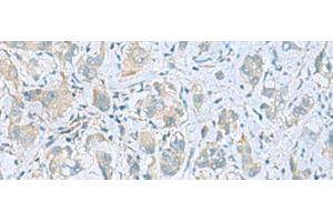 Immunohistochemistry of paraffin-embedded Human liver cancer tissue using PLN Polyclonal Antibody at dilution of 1:45(x200) (Phospholamban 抗体)