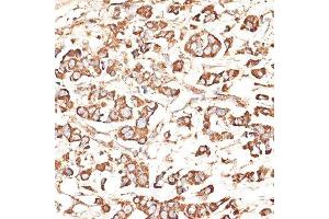 Immunohistochemistry of paraffin-embedded human mammary cancer using KIR3DS1 antibody. (KIR3DS1 抗体  (AA 80-340))