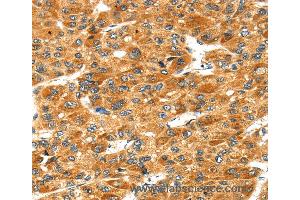 Immunohistochemistry of Human liver cancer using STXBP4 Polyclonal Antibody at dilution of 1:40 (STXBP4 抗体)