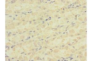 Immunohistochemistry of paraffin-embedded human gastric cancer using ABIN7145065 at dilution of 1:100 (Attractin 抗体  (AA 84-350))