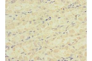Immunohistochemistry of paraffin-embedded human gastric cancer using ABIN7145065 at dilution of 1:100 (Attractin 抗体  (AA 84-350))